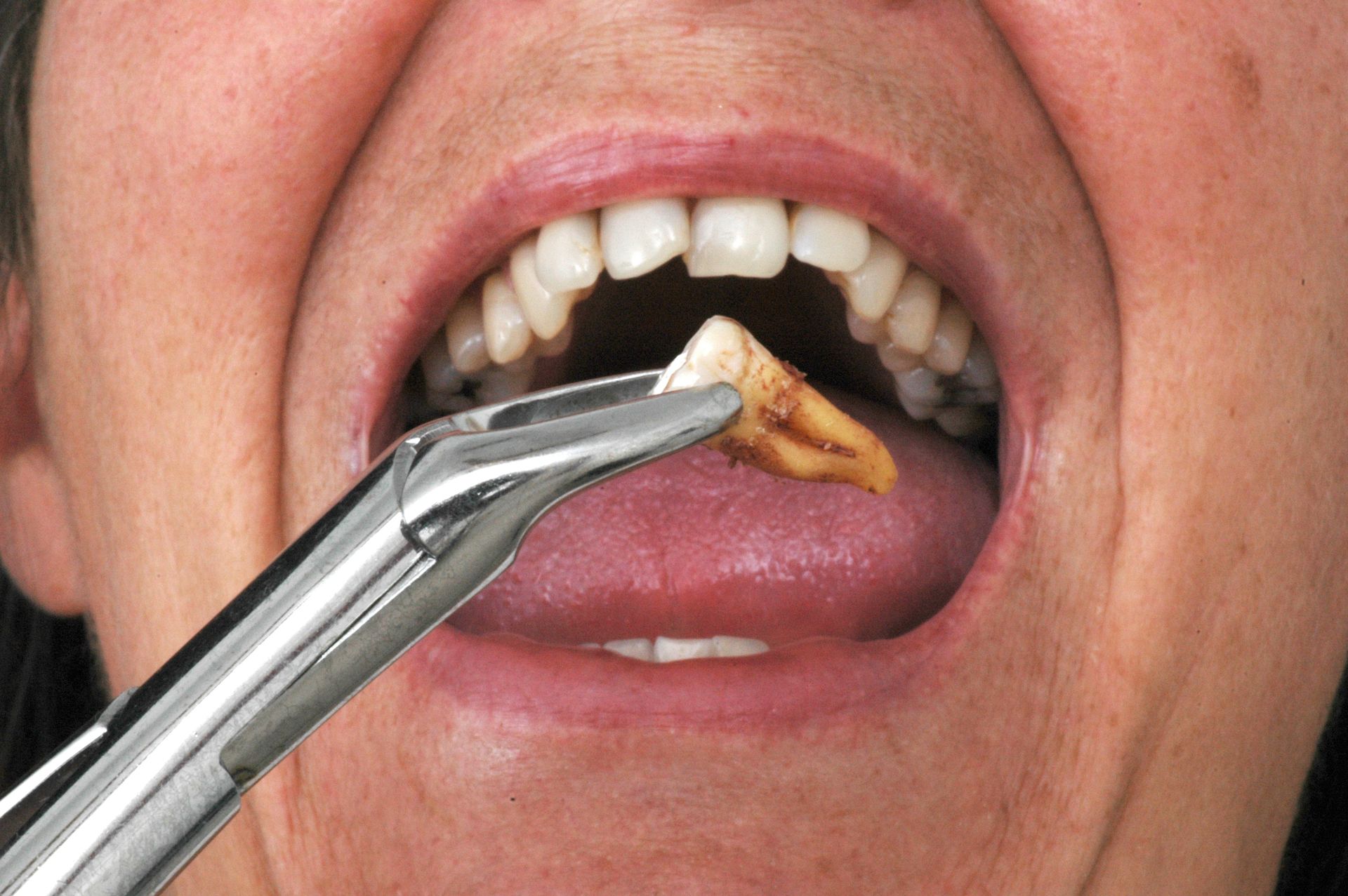 A person is getting a tooth pulled out of their mouth with tweezers.