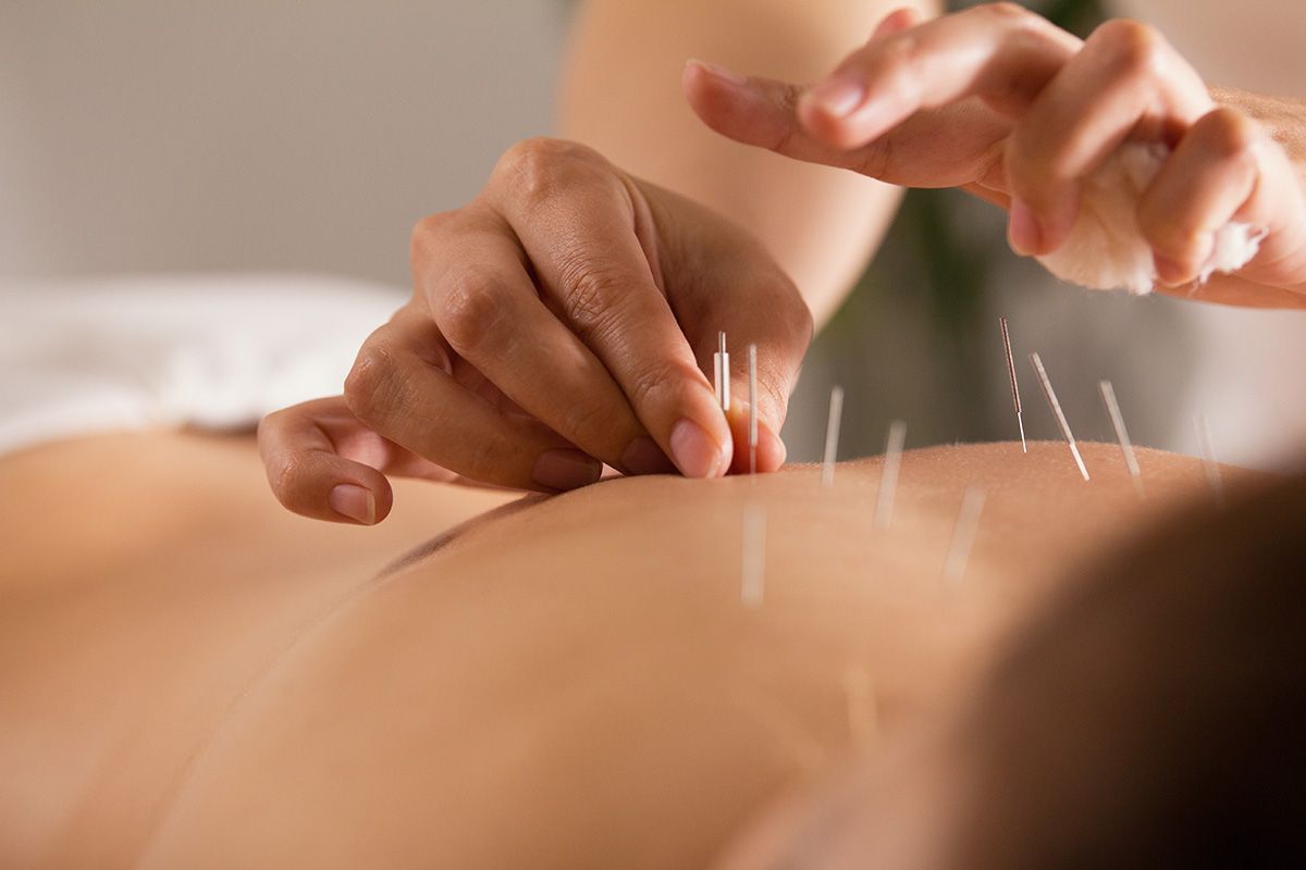 Hands placing acupuncture needles into a person's bare back during a treatment session