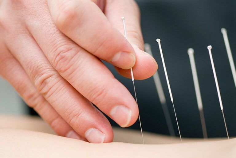 Hand placing an acupuncture needle into skin among several upright needles