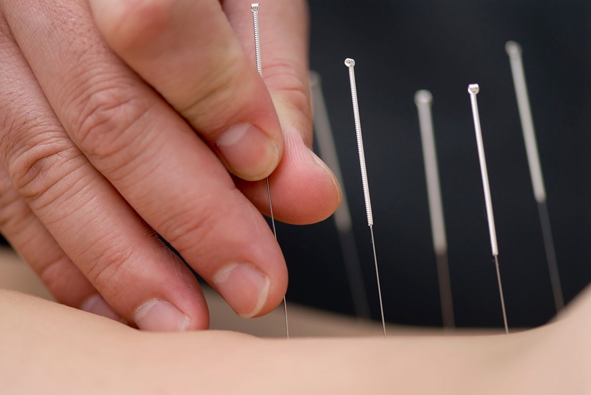 Hands holding a thin thread above metal pins, suggesting acupuncture treatment