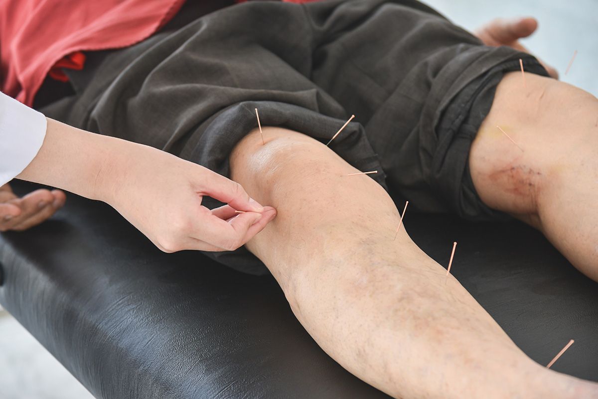 Acupuncturist placing needles in a patient’s lower leg on a treatment table