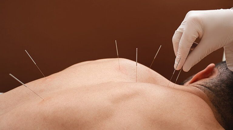 Acupuncture needles inserted into a person’s bare back during a treatment session