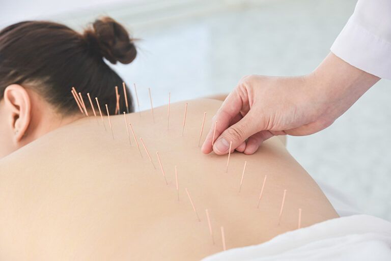 Acupuncture treatment on a person’s back, with needles inserted and a hand placing one near the shoulder
