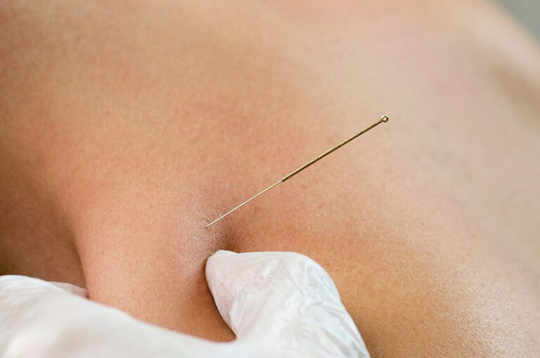 Acupuncture needle inserted into skin near a white-gloved hand