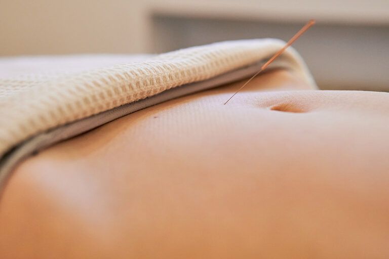 Acupuncture needle inserted into a person’s abdomen beneath a folded towel