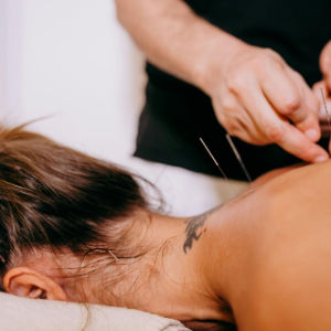 Acupuncture treatment on a woman’s back and neck in a spa setting