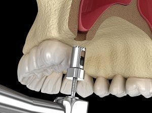 sinus lift colorado sedation dentistry dental implant procedures