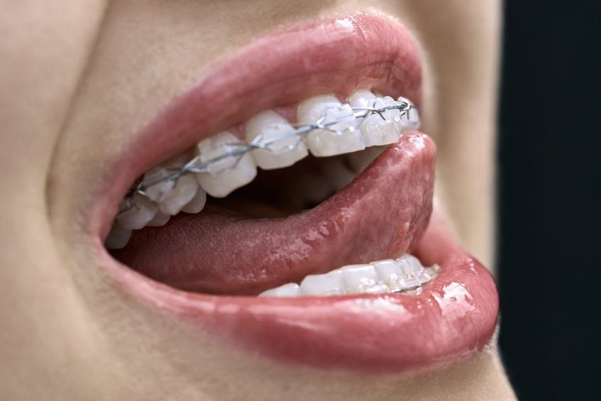 tongue tied frenectomy clarkson dental
