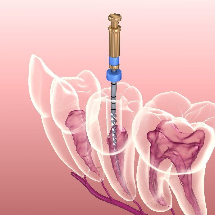 Roof Canal Patient Fears Denver Sedation Dentistry Helps