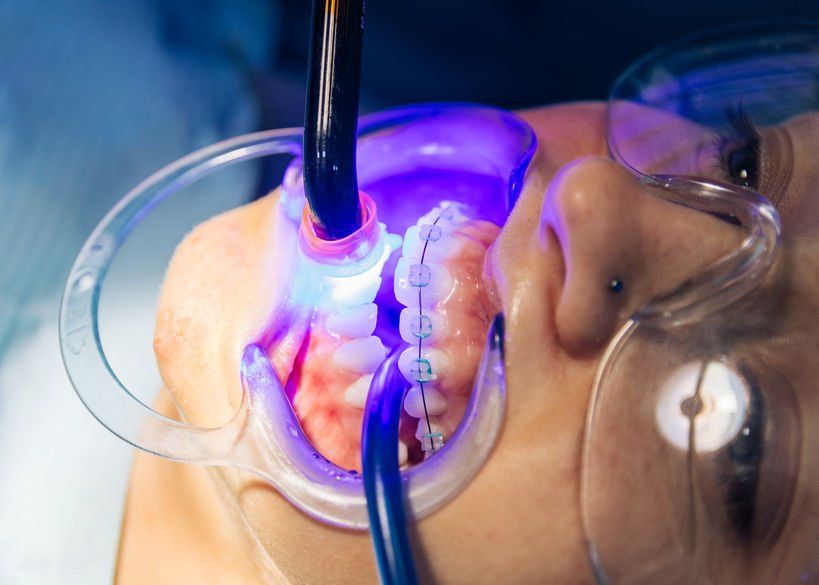 sedation dentistry applying first time braces