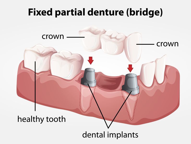 oral sedation dentistry bridge crowns dentist office