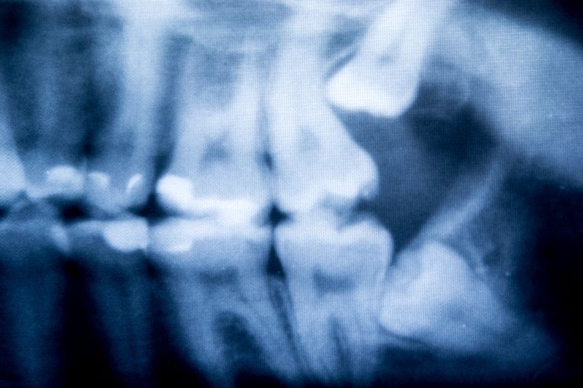 Dental Advice On Wisdom Teeth