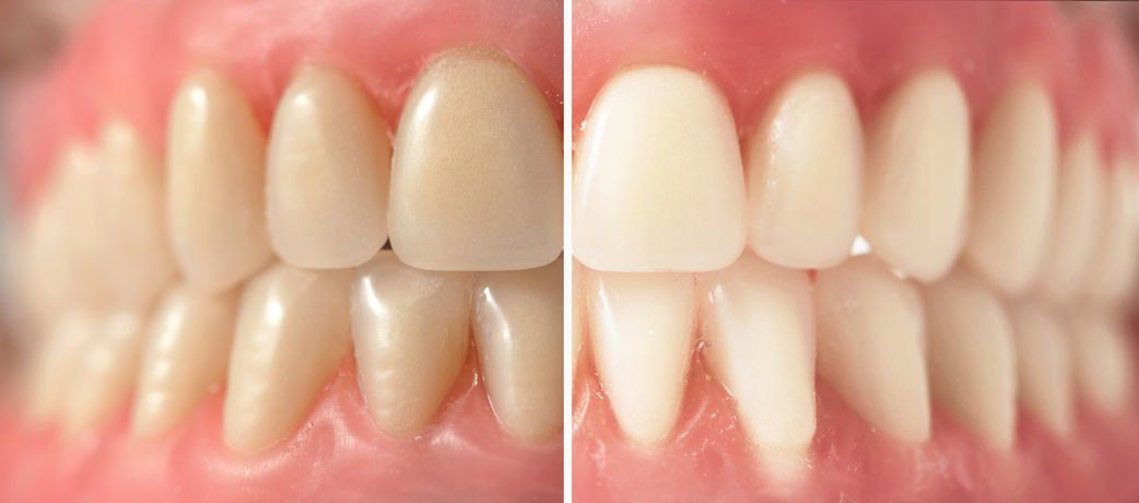 A Sedation Dentistry Office Can Get Rid Of Teeth Stains