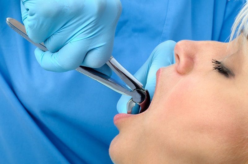 Conscious Sedation Dental Work Clarkson Dental