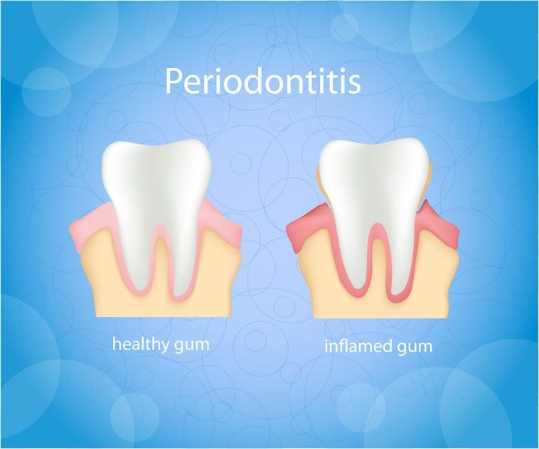 Sedation Dentistry Needed For Deep Cleaning To Eliminate Periodontitis