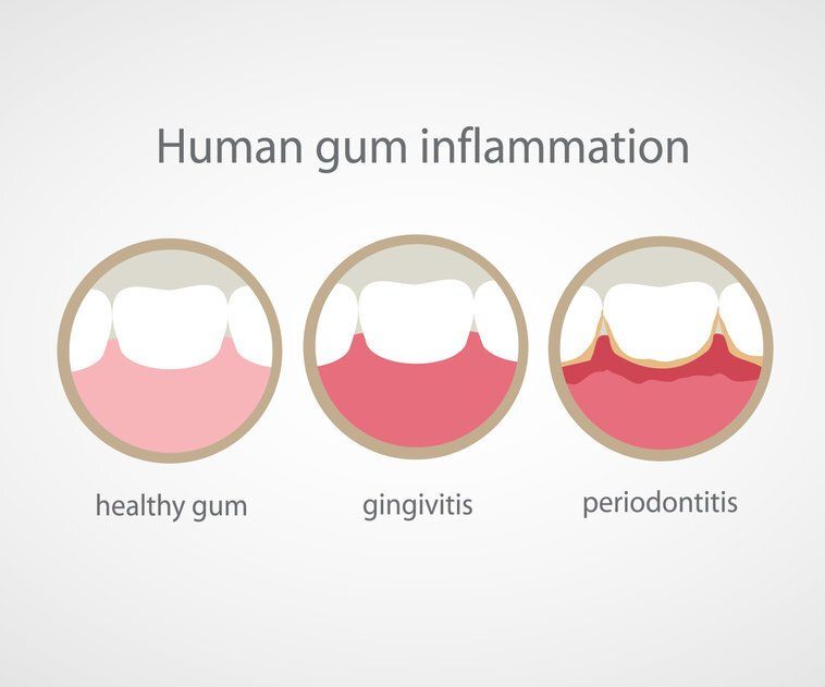 healthy gum gingivitis periodontis sedation dentistry deep cleaning