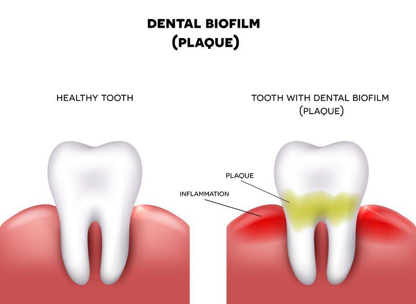 Plaque Can Be Bad For Your Overall Health