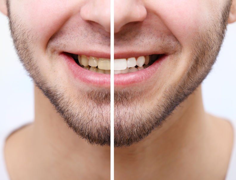 How To Avoid Yello Teeth