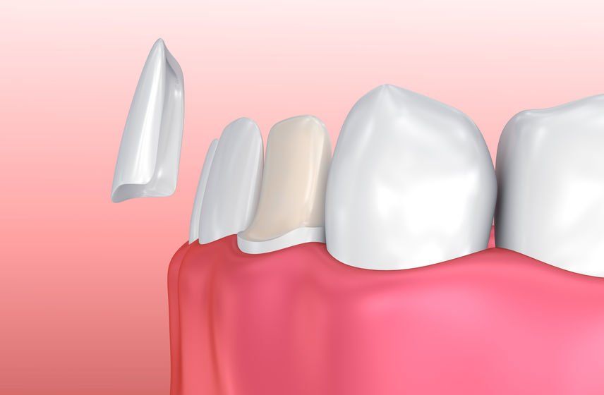 Dental veneer vs bonding clarkson dental example