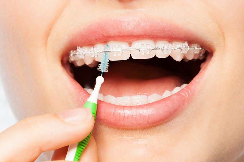 dental picks or floss dentistry sedation braces