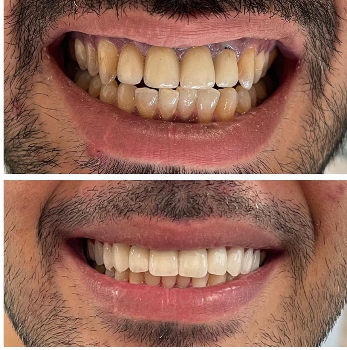 Invisalign Tilbyder Oslo