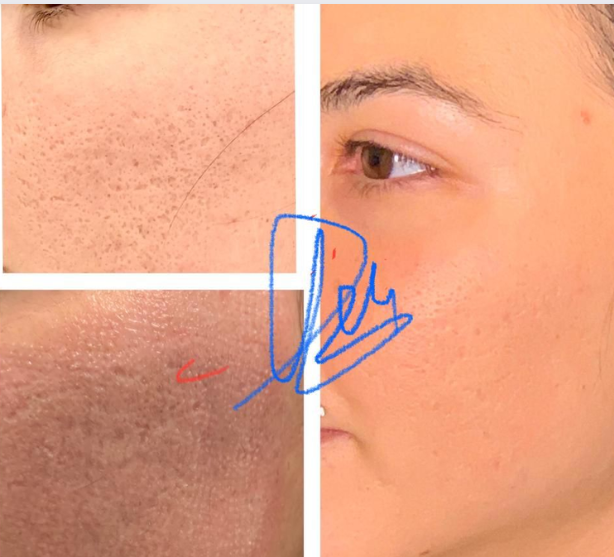 trattamento cicatrici