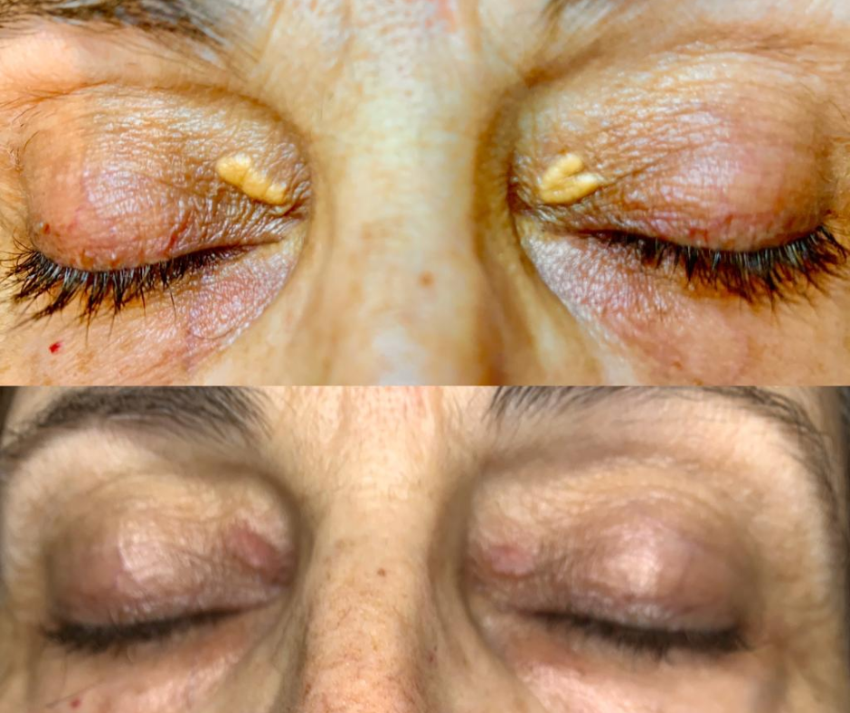 asportazione angiomi