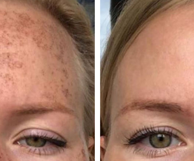 trattamento macchie cutanee