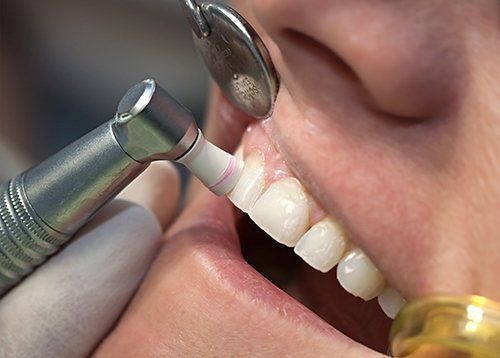 Restorative teeth polishing dentistry services in Avon, NY