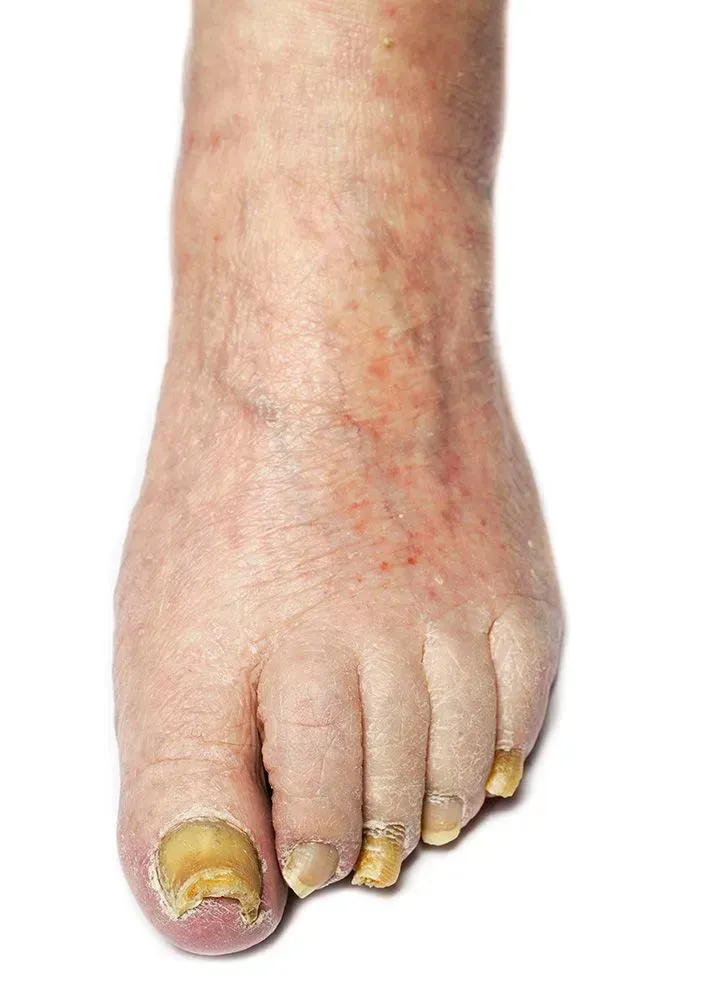 A human foot with thickened, discolored, and distorted toenails, characteristic of a fungal infection.