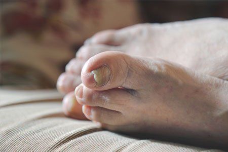 Fungal Nail Infections