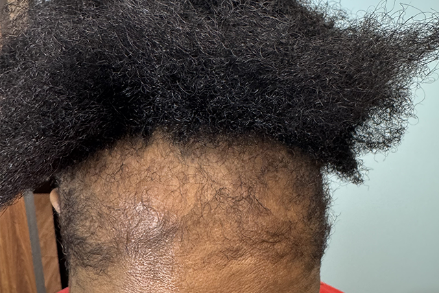 Close-up of hair showing a receding hairline with visible scalp and dark, textured hair on top.
