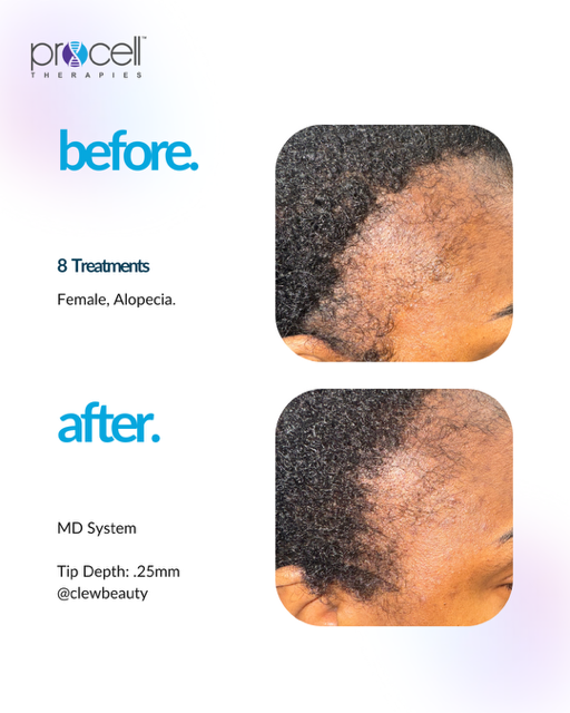 Side-by-side hair growth comparison. Before shows thinning hair, after shows improved growth after 8 treatments.