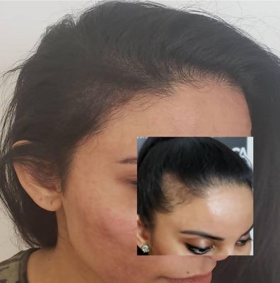Woman with thinning hairline, a smaller inset shows a close-up of the hairline.