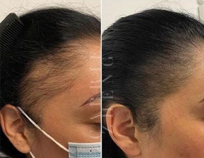 Before and after of a woman's hairline showing hair growth, possibly from a hair treatment.
