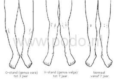 O-benen of genu varum bij kinderen