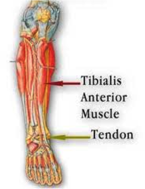 Tibialis Anterior tendinitis