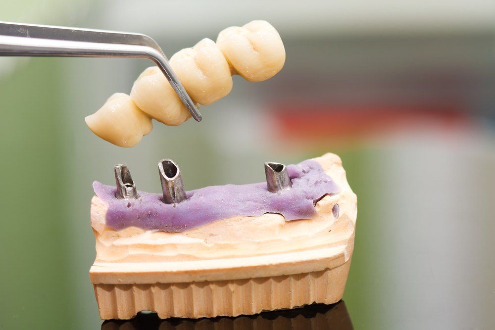 A Dental Bridge is Being Built on a Model of a Tooth — Complete Denture Clinic in Kanwal, NSW