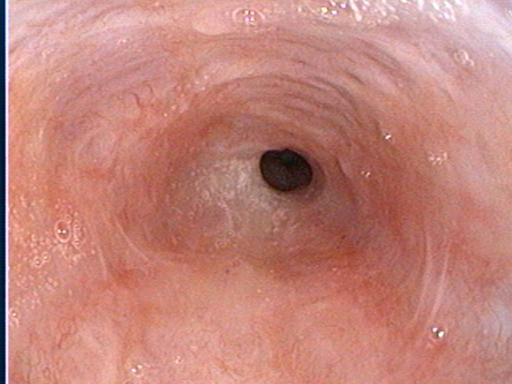 Endoscopic view inside the esophagus, showing a dark, round opening at the center surrounded by pink tissue.