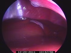 Endoscopic view of the inside of the abdomen, showing the liver and other tissues, dated December 20, 2011.