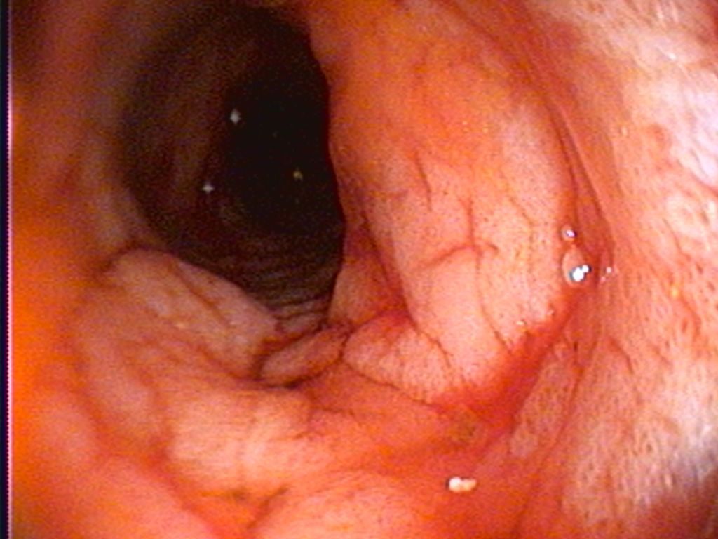 Endoscopic view of the colon interior, showing reddish, textured tissue and folds.