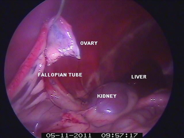 Laparoscopic view of a female reproductive system; ovary, fallopian tube, kidney, and liver visible.