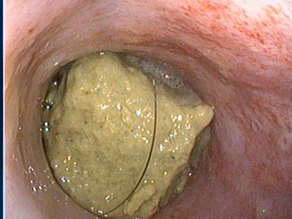 Endoscopic view of a large, yellow gallstone lodged in a bile duct.