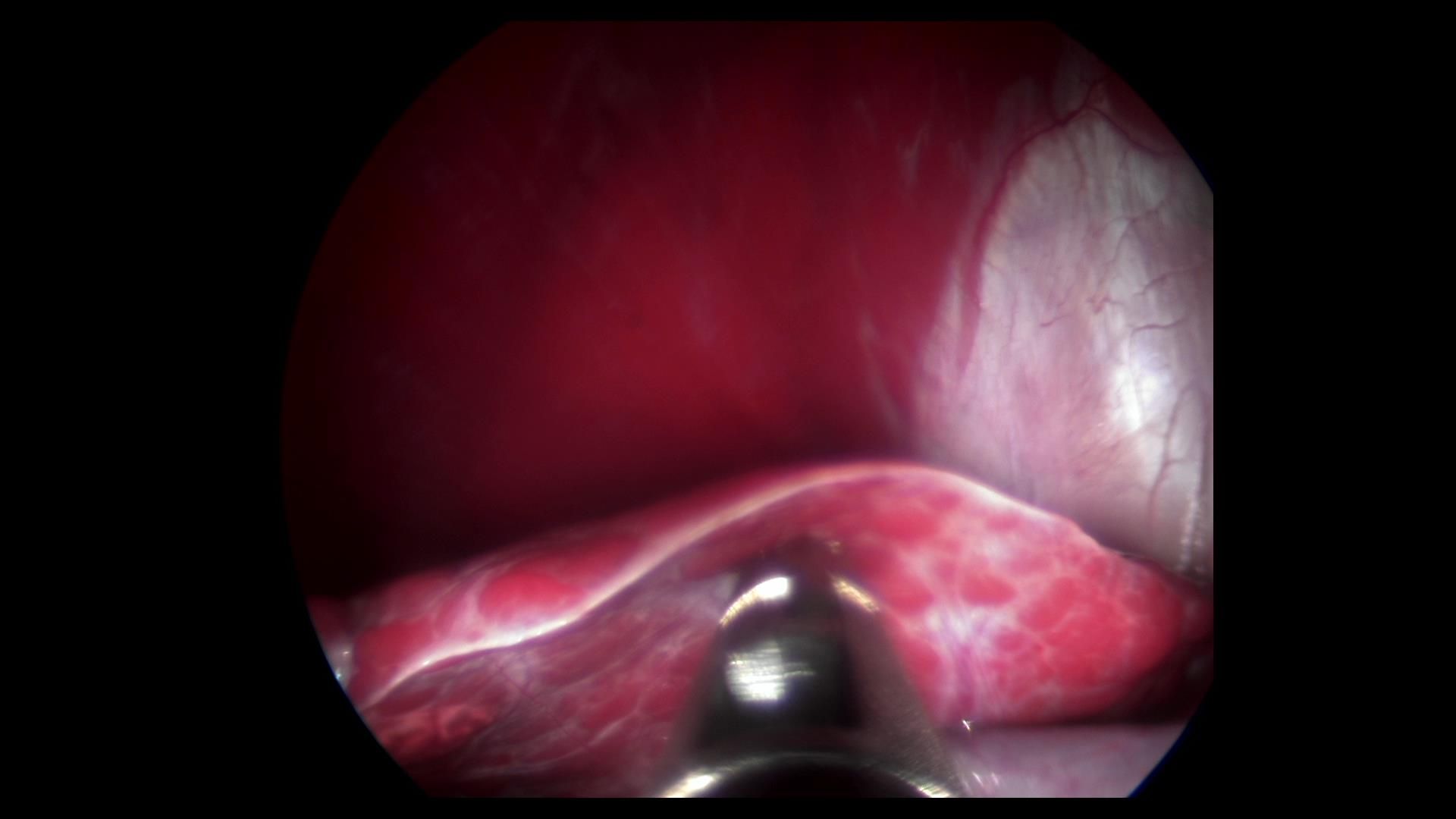 Endoscopic view of a deep red organ, possibly the liver, with a silver surgical tool at the bottom.