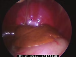 Endoscopic view of the abdomen, showing the liver and other organs in reddish-brown hues.