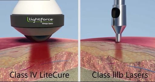 Class IV and Class III lasers - laser therapy in Lynnwood, WA