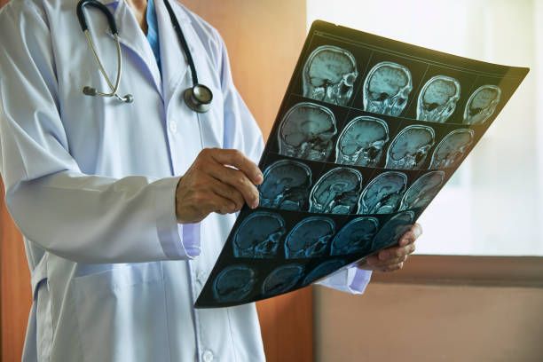 A doctor is holding an X-ray of a person's brain – Saint Joseph, MO – Eslinger Law Firm