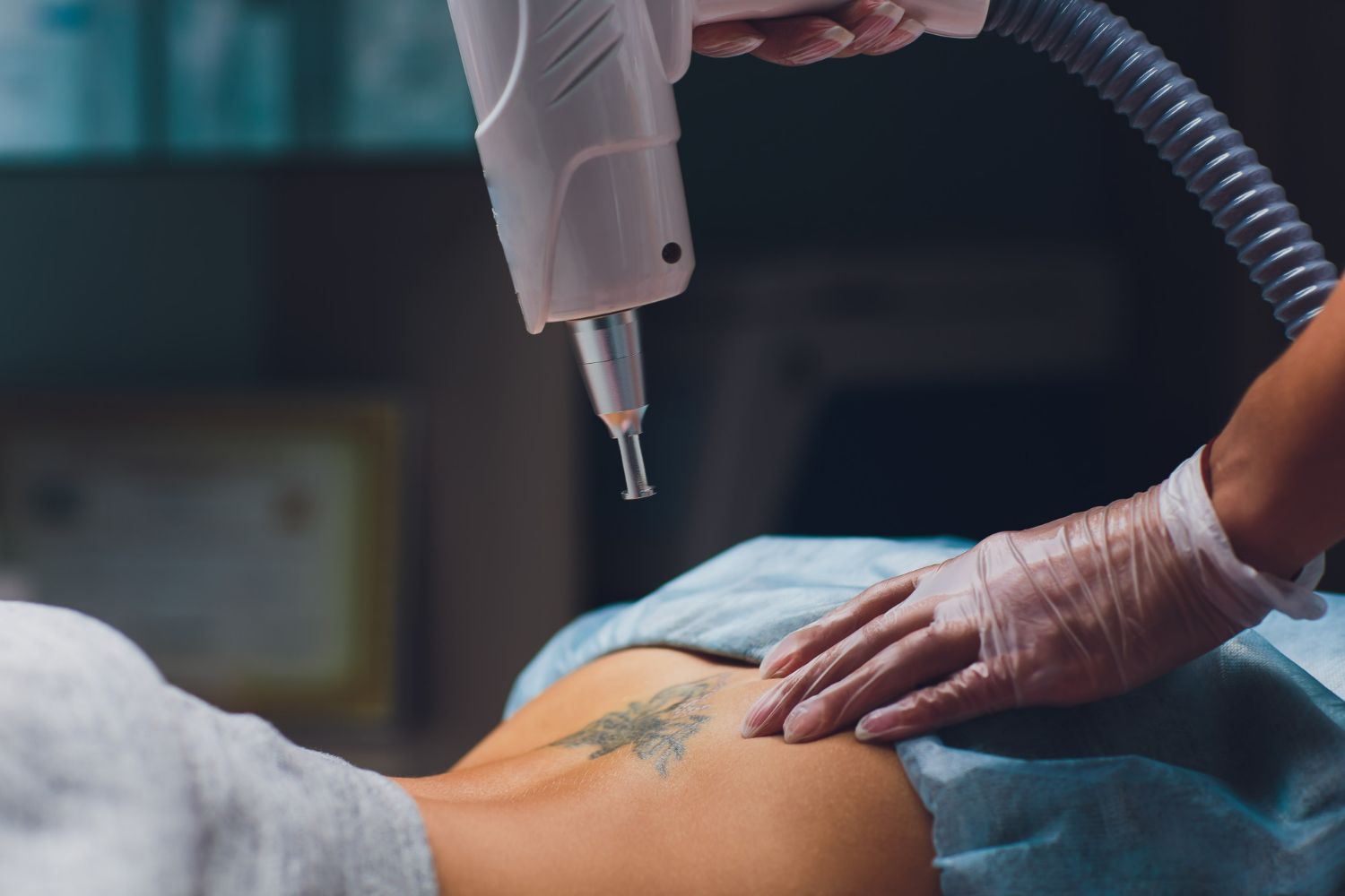 Laser tattoo removal on a person's back, a gloved hand holding the laser device.
