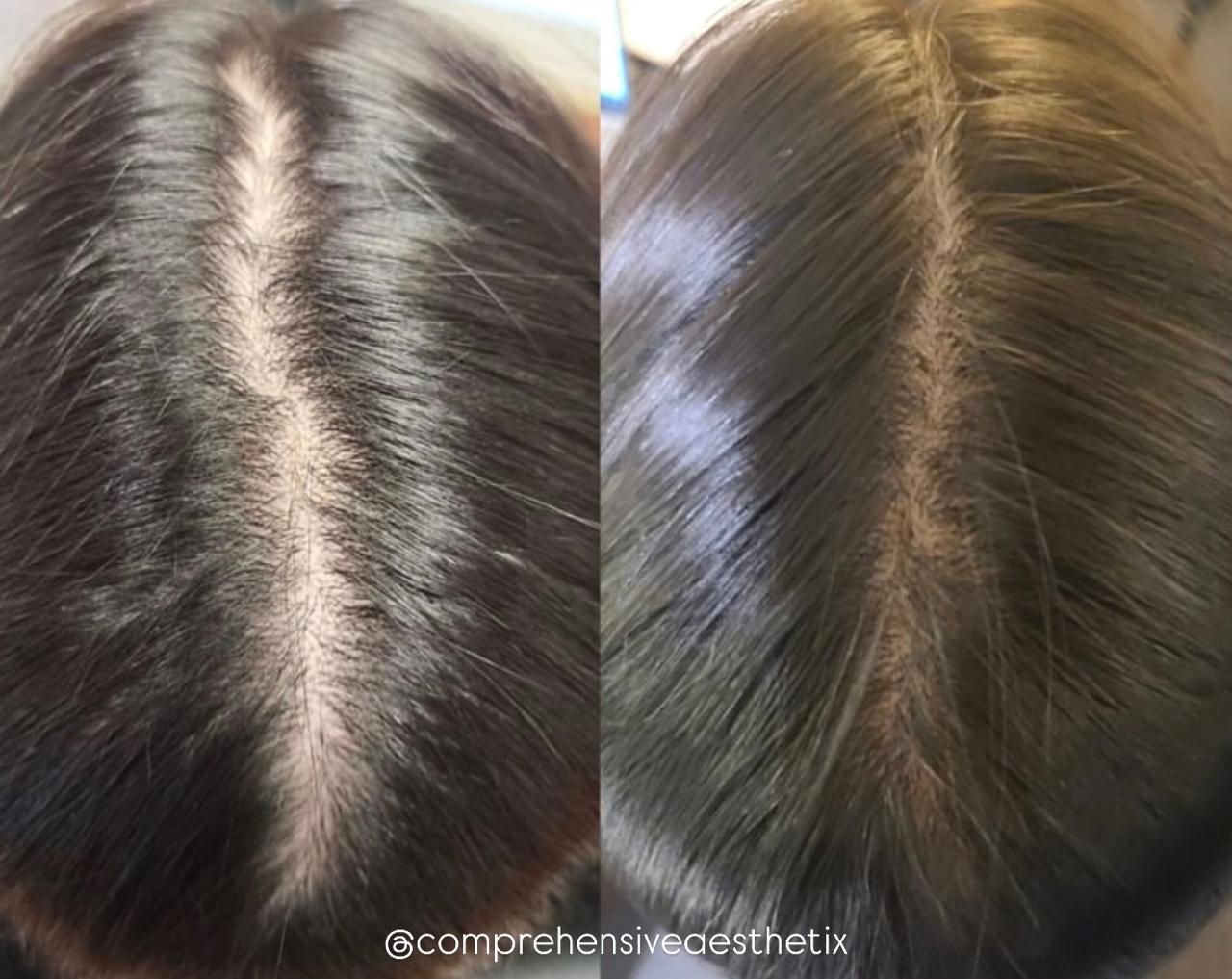 Before and after photos of a person's scalp, showing a fuller look after hair regrowth treatment.