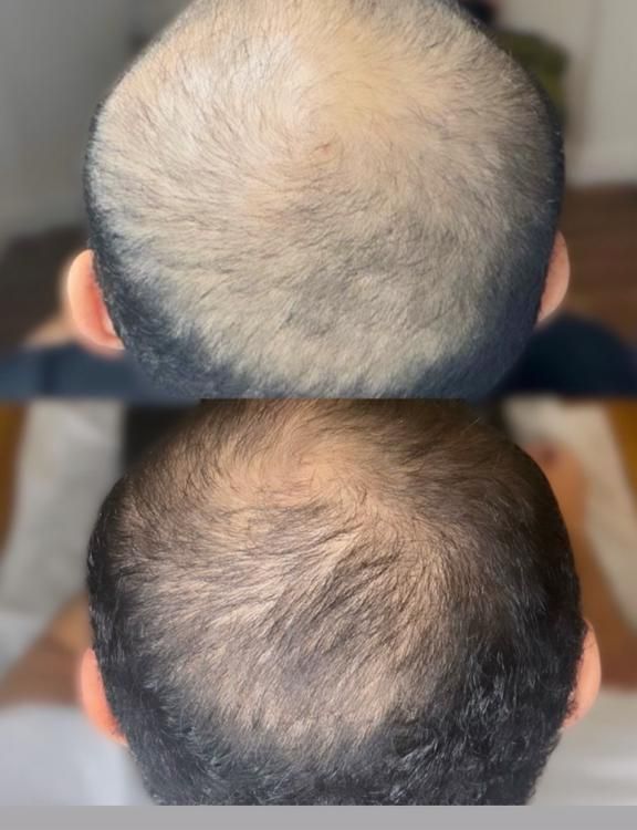 A before and after picture of a man 's hair growth.